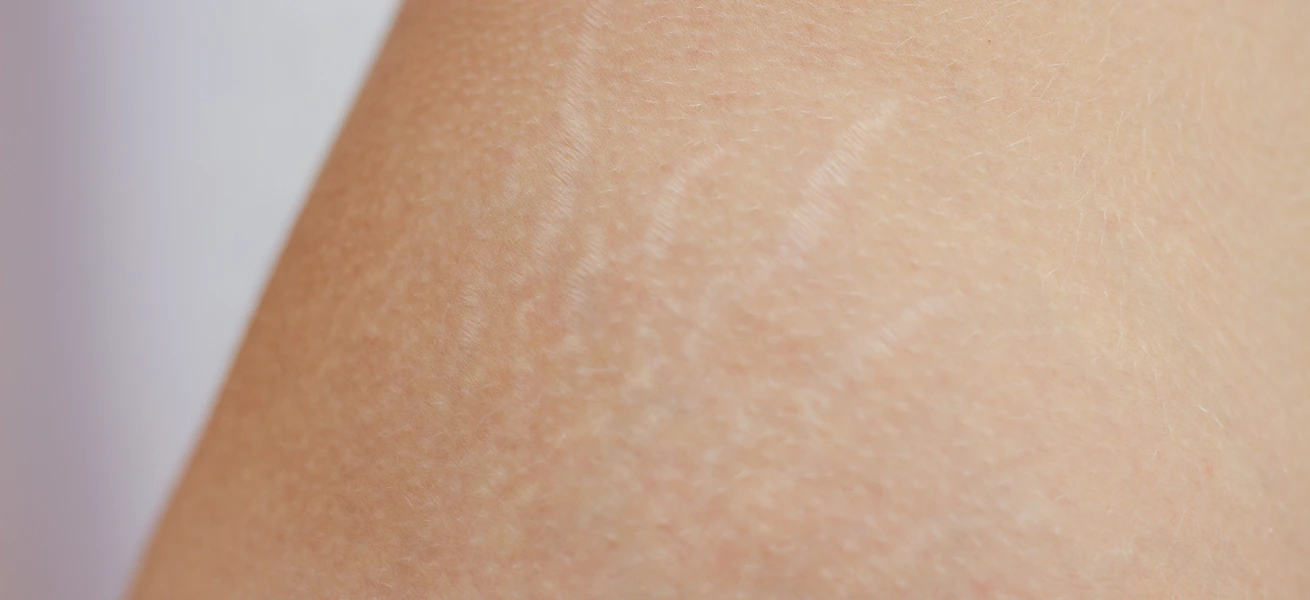 Nahaufnahme von heller Haut mit feinen Dehnungsstreifen